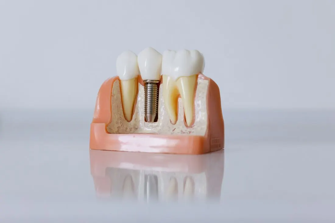 Close-up of a dental teaching model on a white surface showing three crowns, with a metal implant screw in the jaw section between two natural tooth roots. Photo by cottonbro studio on Pexels